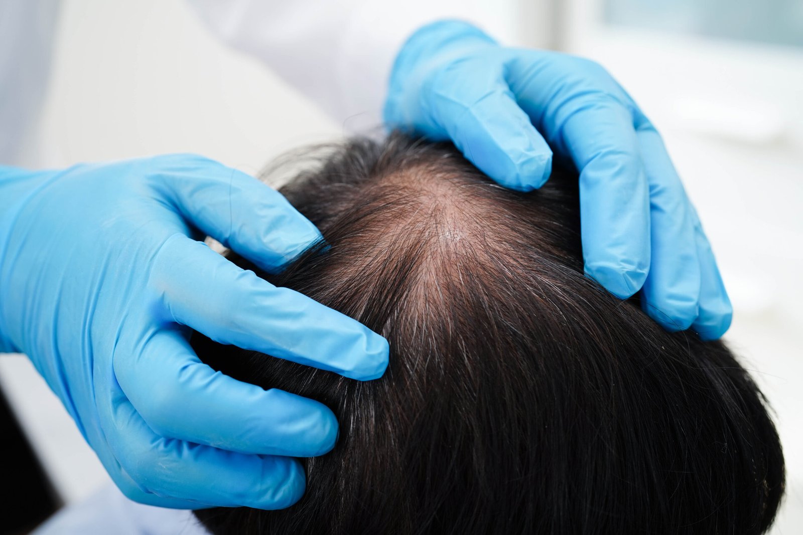 Cuir chevelu et chute de cheveux : comprendre le lien pour mieux agir 2026