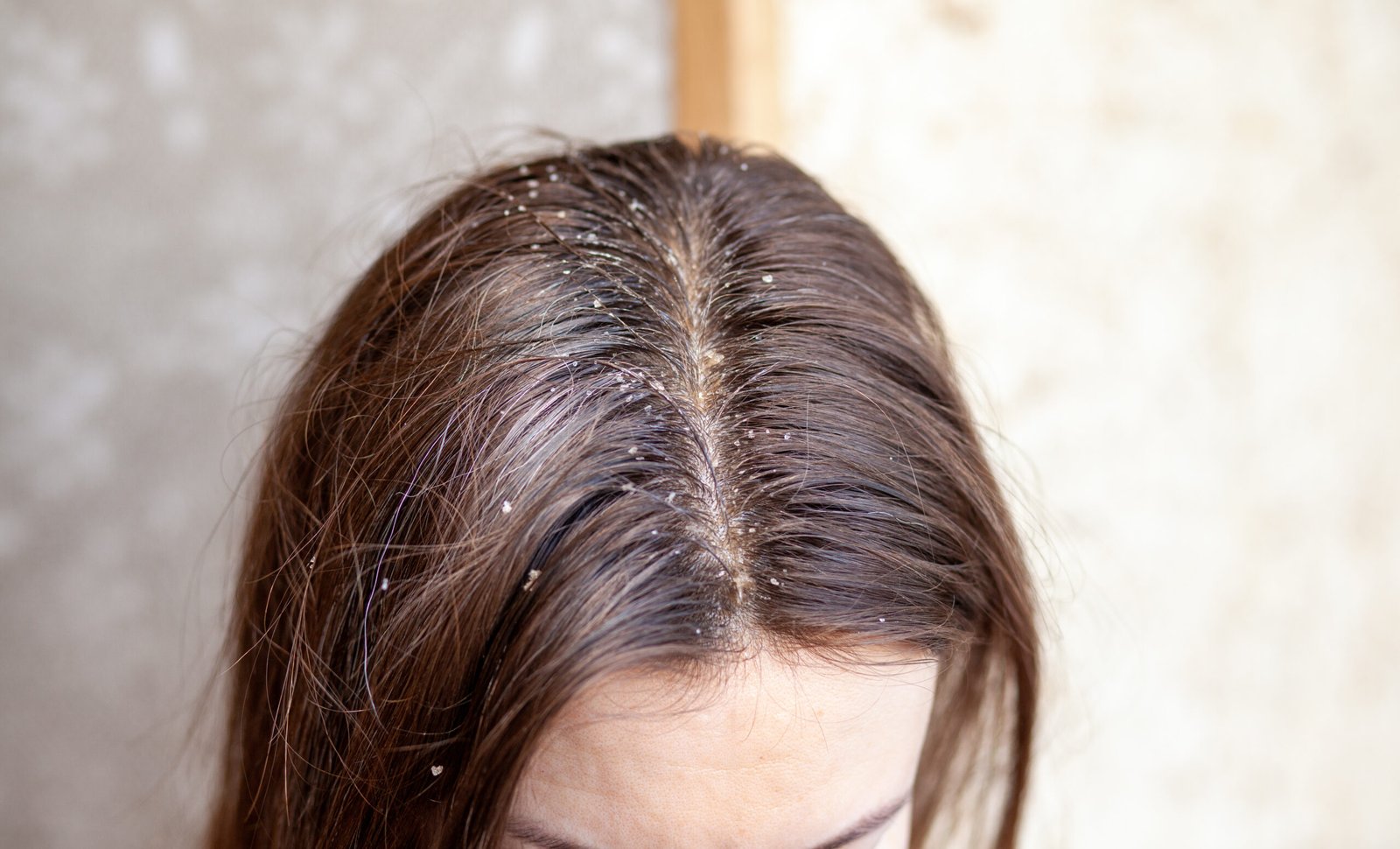 Pellicules sèches ou grasses : comment savoir et faire la différence ? 2026