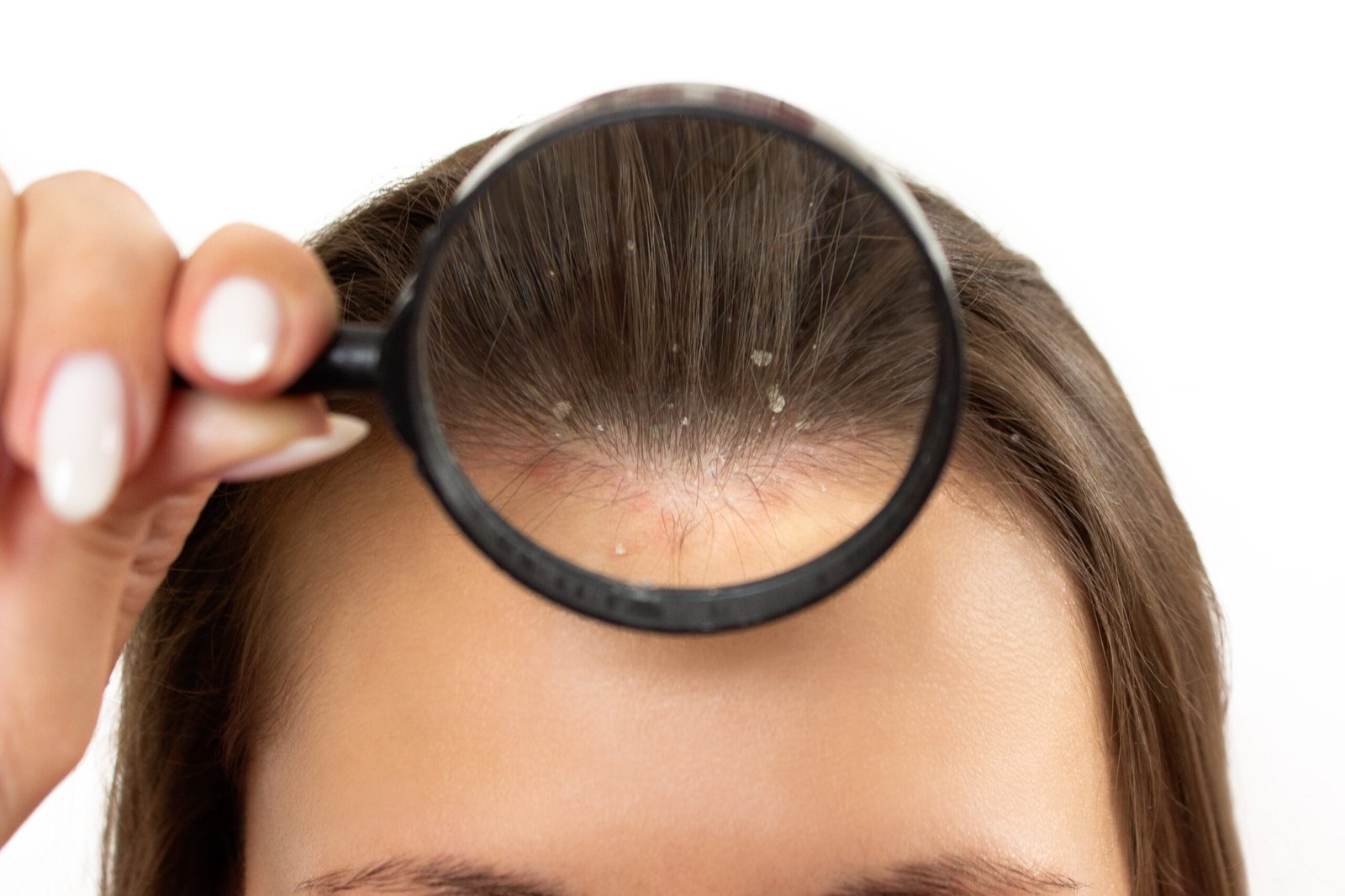 Pellicules qui reviennent : pourquoi et quoi faire pour les stabiliser 2026